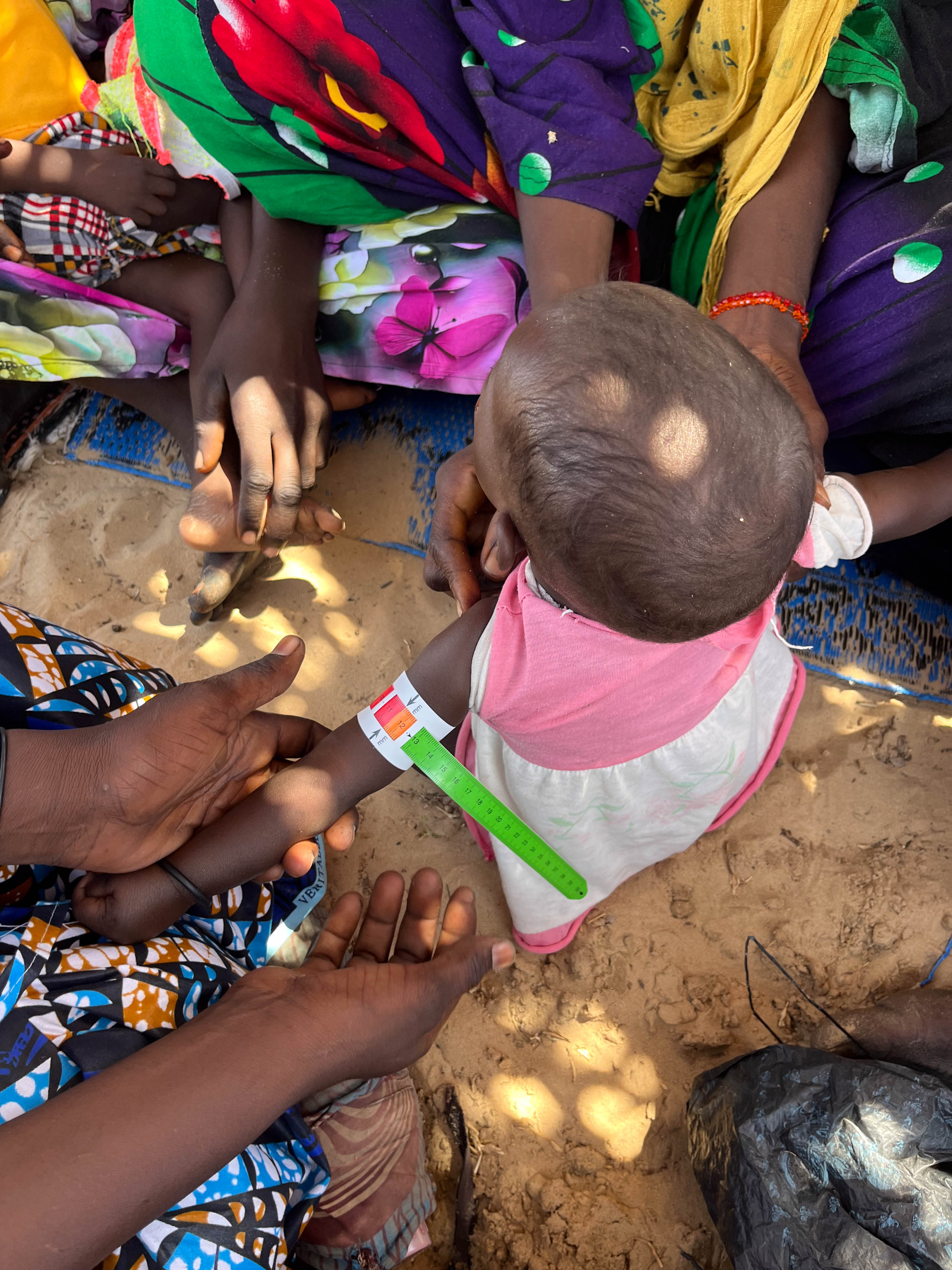 De arm van een kindje wordt gemeten om op die manier te kijken of hij ondervoed is.
