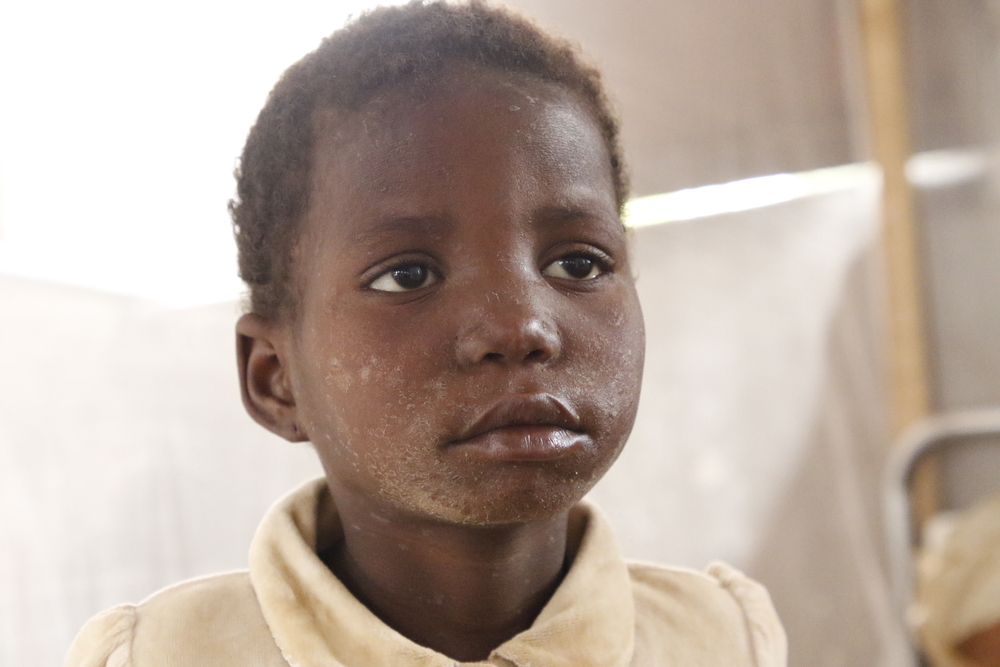 De 9-jarige Obulu Solange wordt in het Bosobolo General Referral Hospital behandeld voor mazelen. Ze komt uit het dorp Dumbulu, dat op 50 km afstand van Bosobolo ligt. "Ik heb haar hierheen gebracht voor goede zorg, want ze had rode ogen en uitslag", zegt haar moeder Onie. "We gingen eerst naar het gezondheidscentrum in Dumbulu, maar daar werd ze niet beter. Ze hebben ons hierheen overgebracht. Nu gaat het goed met haar. Er zijn zo veel gevallen van mazelen in ons dorp. Ik heb veel kinderen gezien met uitslag op de huid, roodheid in hun ogen, zoals Solange. Er sterven ook kinderen aan. "  Vertaald met www.DeepL.com/Translator (gratis versie)