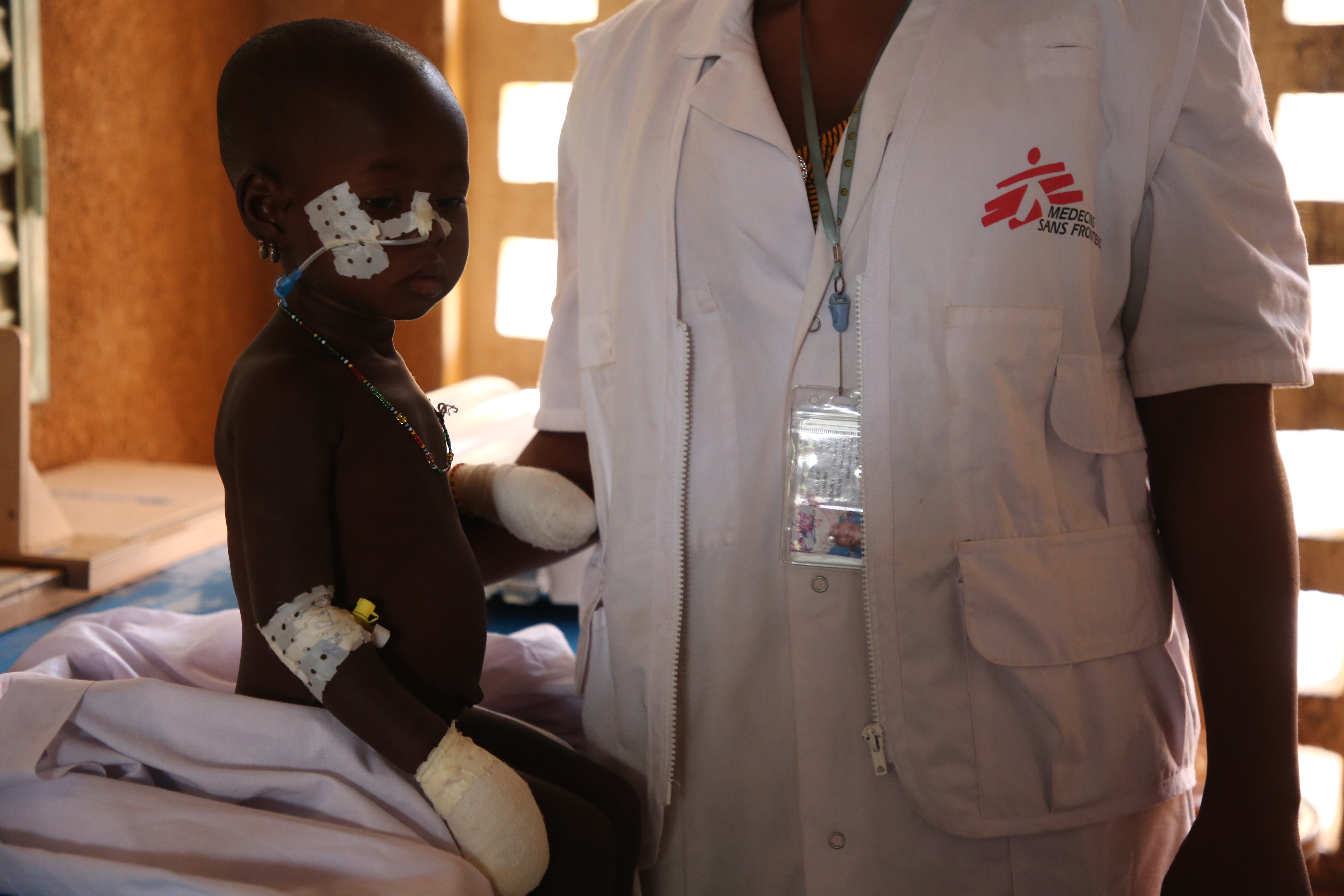 een ondervoed kind van 2 jaar wordt behandeld in Ansongo.