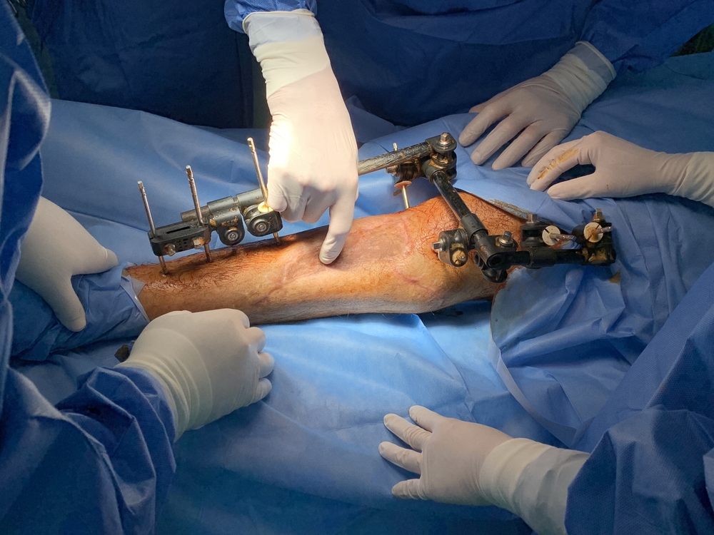 Deze chirurgen bespreken hoe de eerste incisie in het been van Yousri kan worden gemaakt, die een bottransplantatie nodig heeft. Yousri werd door het Israëlische leger neergeschoten tijdens demonstraties in Gaza in juli 2018. Al-Awda ziekenhuis, Palestina, januari 2019. © Jacob Burns/AZG
