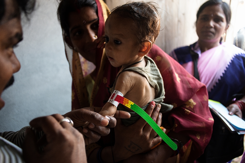Un enfant souffrant de malnutrition sévère est pris en charge par Médecins Sans Frontières dans l'hôpital de Sadar à Bihar © Sami Siva. Inde, 2014.   