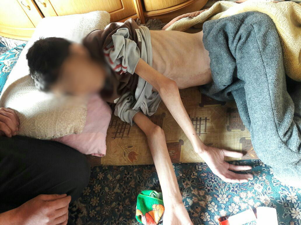 Mohammed, 17, stierf aan ondervoeding 2 dagen nadat deze foto genomen werd. Hij was al vijf maanden in behandeling wegens een fysiek trauma met neurologische gevolgen, maar door gebrek aan het nodige medische materiaal en voedsel kon hij niet genezen. Hij raakte steeds sterker ondervoed en verzwakte, tot hij op 4 april overleed. © AZG. 2 april 2015, Madaya. 