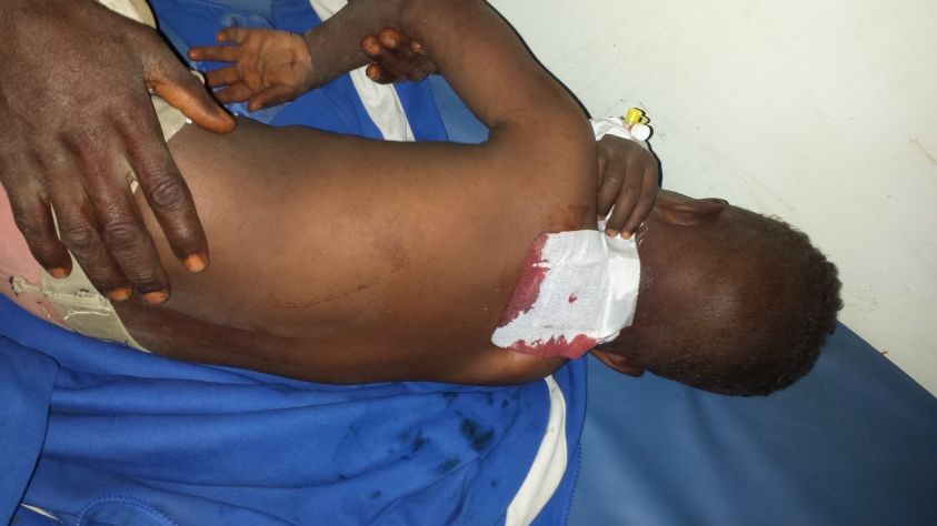 Een kind van twee jaar kreeg een granaatscherf in de nek tijdens de bombardementen. © Artsen Zonder Grenzen.