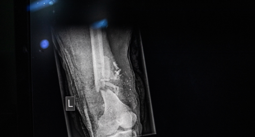 Radiographie de la jambe gauche de Hamoud, après avoir été touché par un tireur d'élite près de Hodeidah. © Agnes Varraine-Leca, décembre 2018