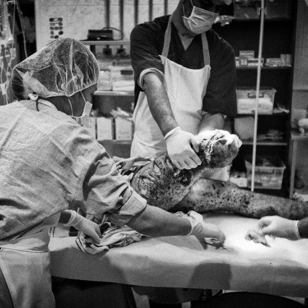 Un patient, qui a perdu la partie inférieure de sa jambe, est pris en charge par MSF